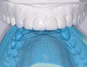 Read more about the article Heroic Dentistry: Compassionate Smile Rescue with ACTIVA BioACTIVE-RESTORATIVE