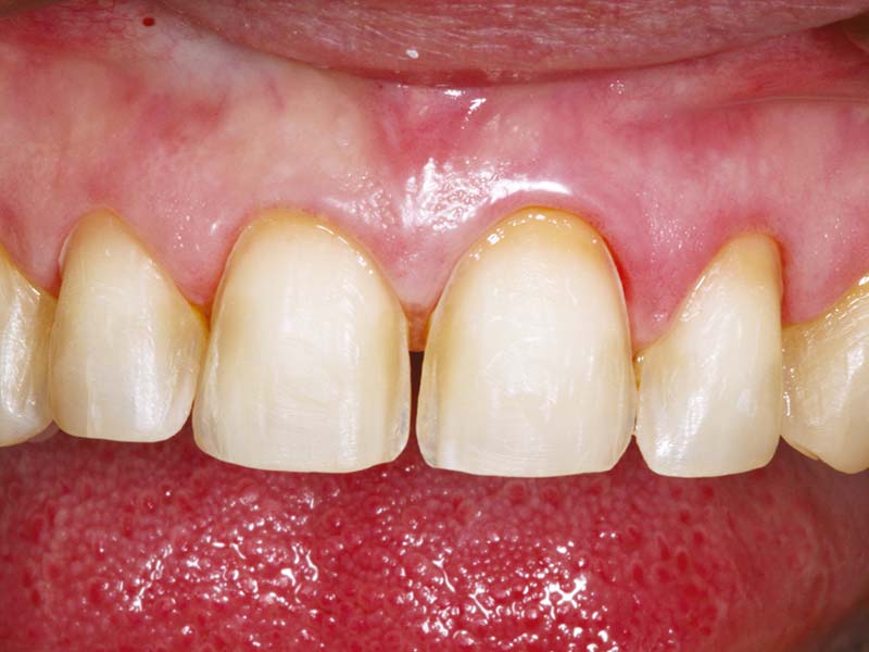 clinical-procedure1-kleer-veneer-2