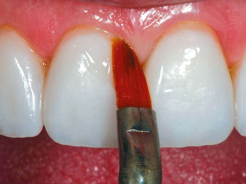 clinical-procedure1-kleer-veneer-3