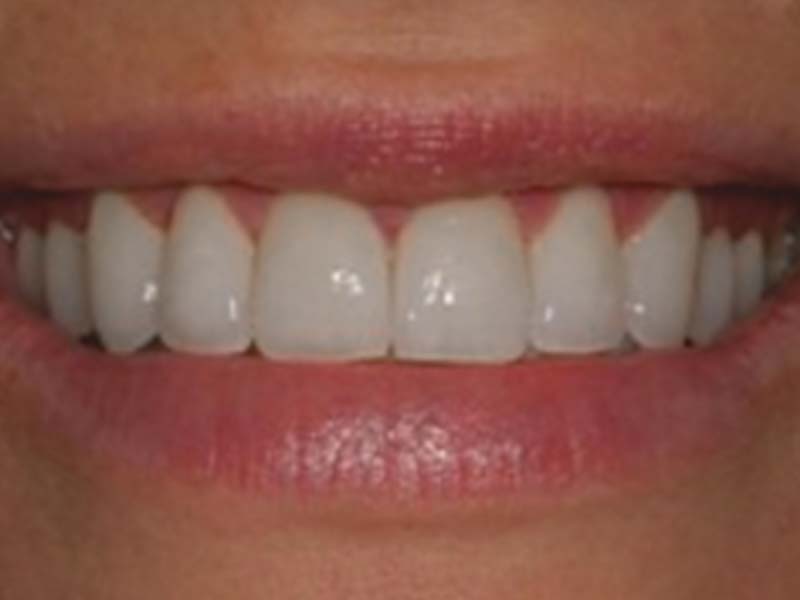 clinical-procedure2-kleer-veneer-11