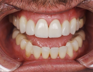 Read more about the article Direct from the Operatory: Bioactive Cementation