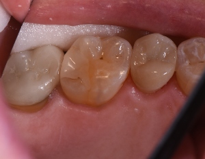 Read more about the article Direct from the Operatory: Cementation Made Simple