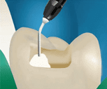 Read more about the article 3 Reasons to Use a Stackable Composite