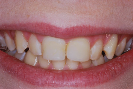 beforeafter1-2