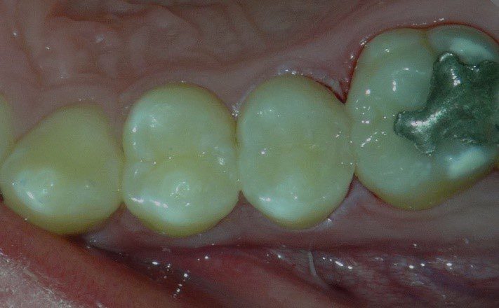Read more about the article Direct from the Operatory: Minimally Invasive Bioactive Restorations