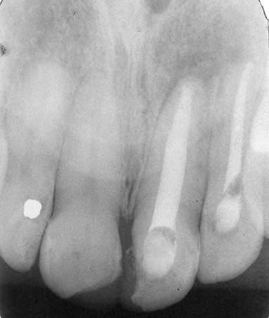 Read more about the article Successful Treatment of Long-standing Periapical Lesion