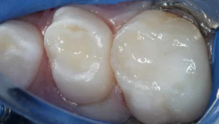 Read more about the article Bioactive restorations in pediatric dentistry