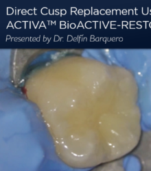Direct Cusp Replacement Using a Bioactive Restorative