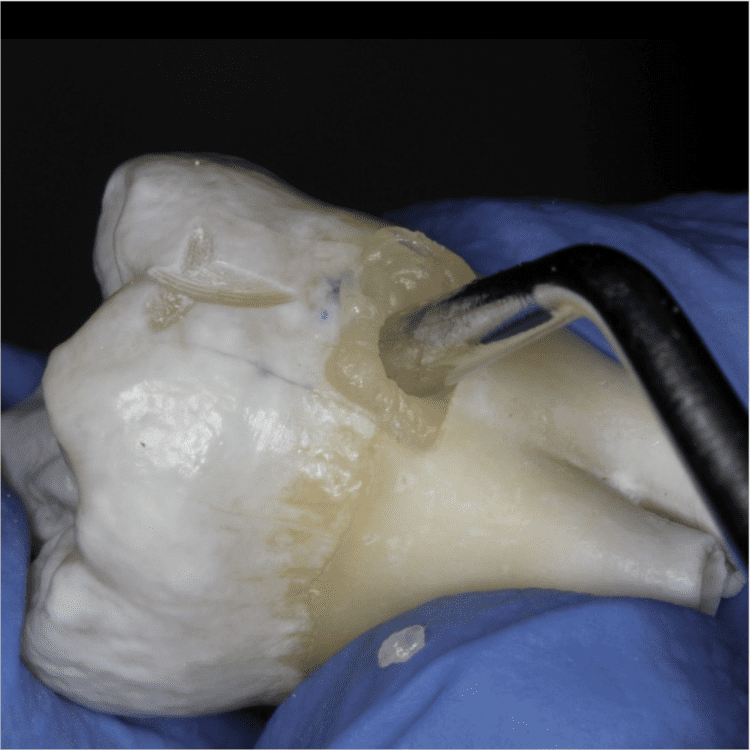 Read more about the article Activa BioActive-Restorative: A Study on its Protective Effect Against Demineralization